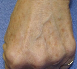 age spots